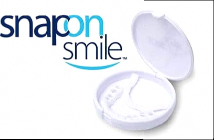 Snap-on Smile - che cos'è